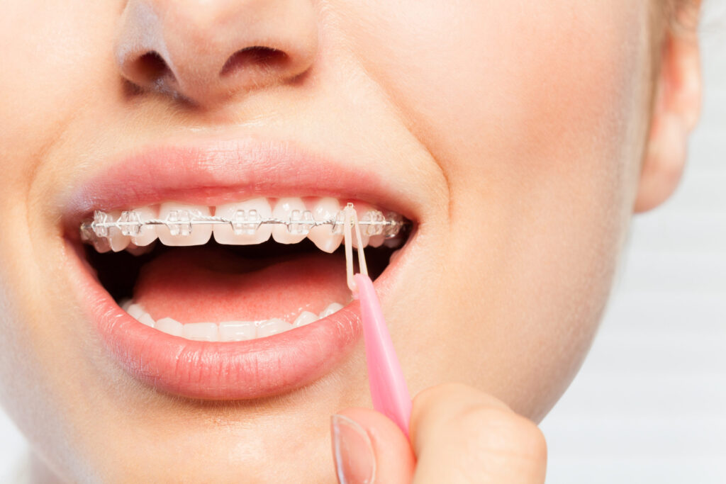 Elastics, rubber bands, orthodontic appliances, woman using a tool to attach a rubber band to her top braces and bottom braces