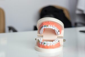 3D model of teeth with traditional braces and clear braces on one, teeth model on top of counter