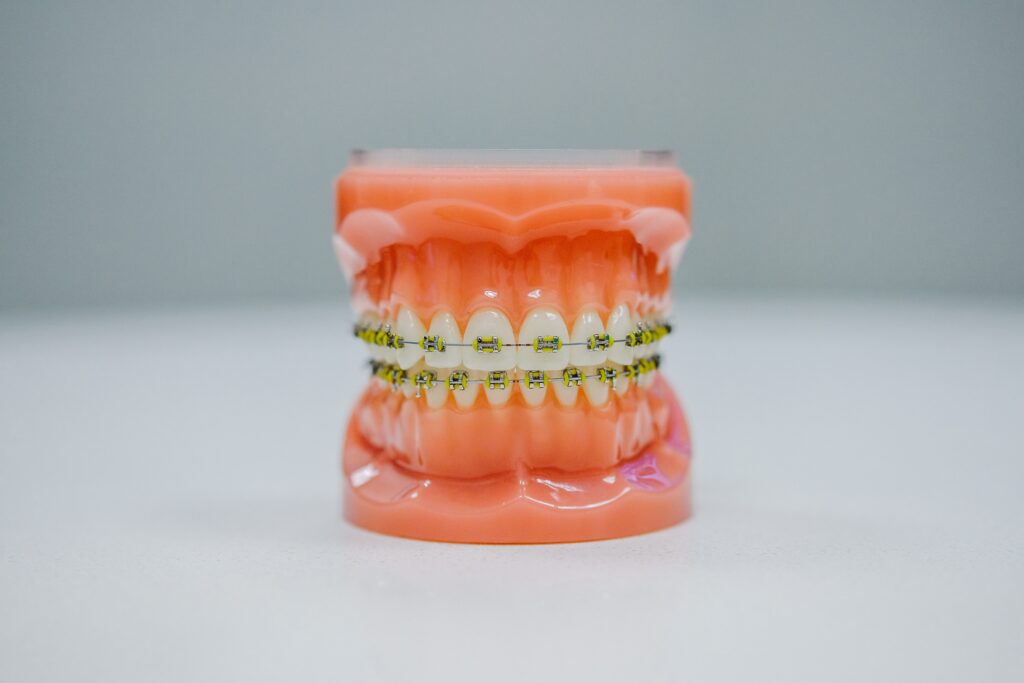 How braces have changed over the years, Model of braces on teeth with white background, Cool Braces